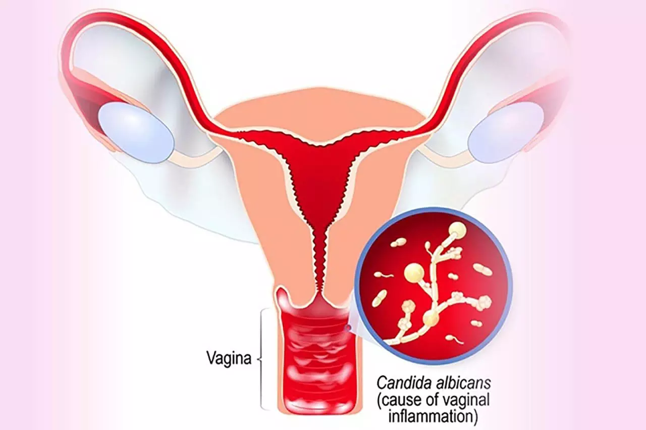 biểu hiện của nấm âm đạo