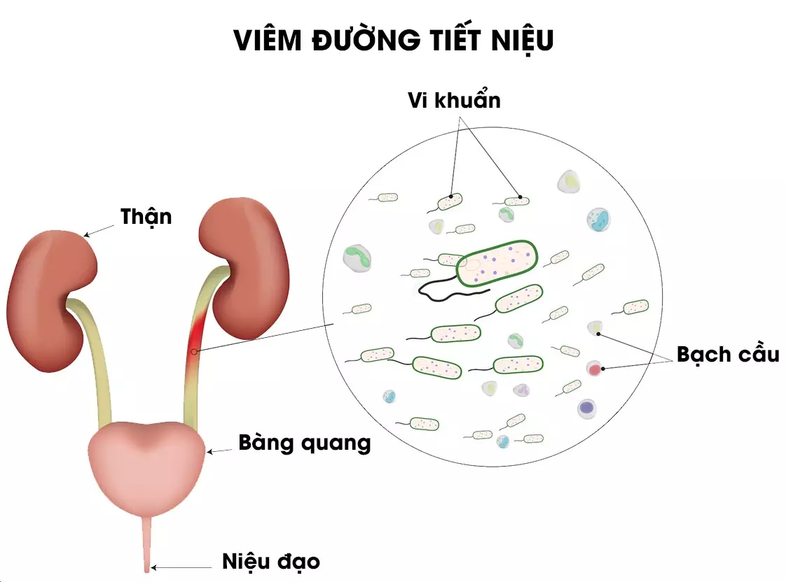 viêm đường tiết niệu