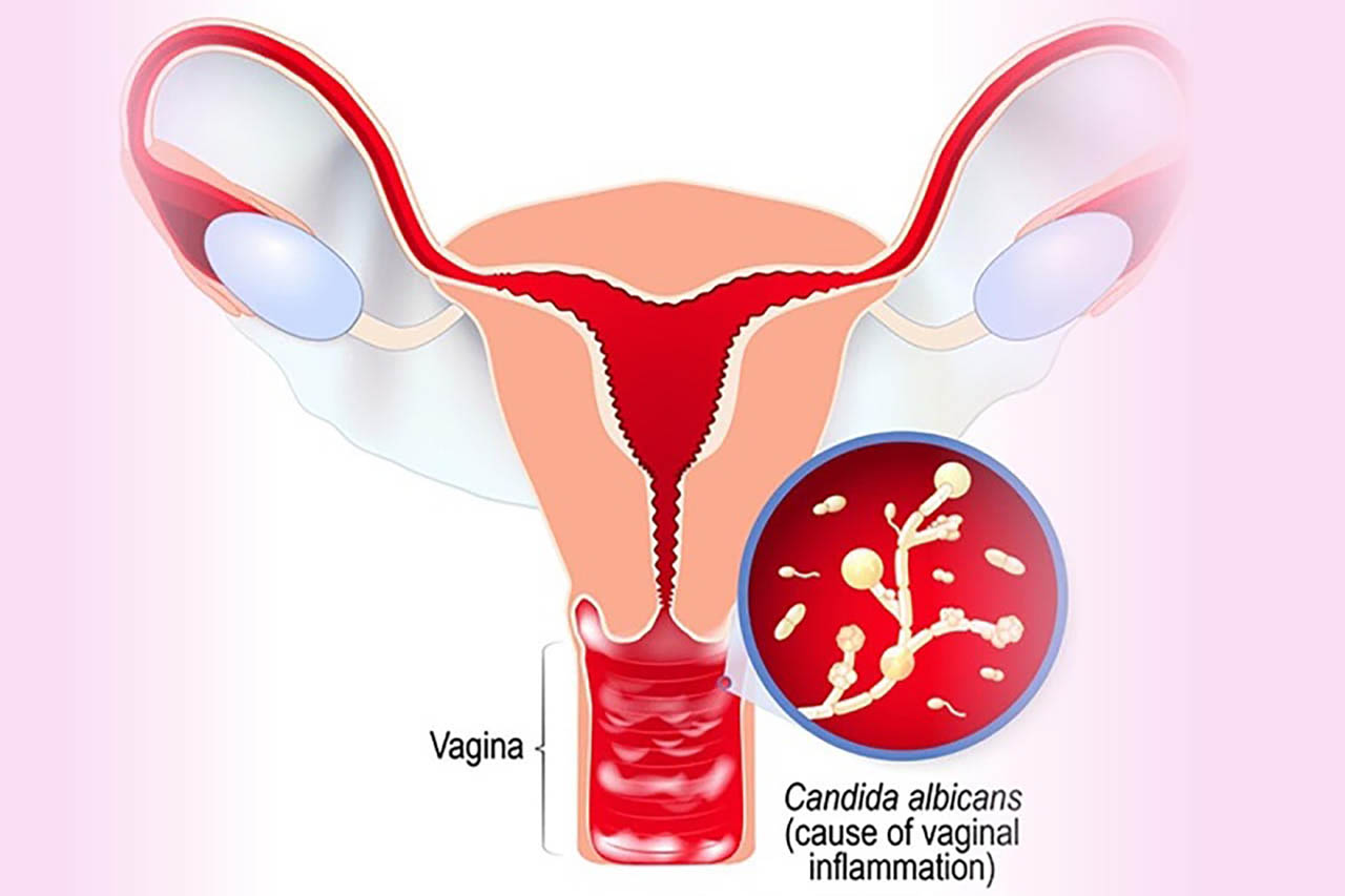 biểu hiện nhiễm nấm candida âm đạo