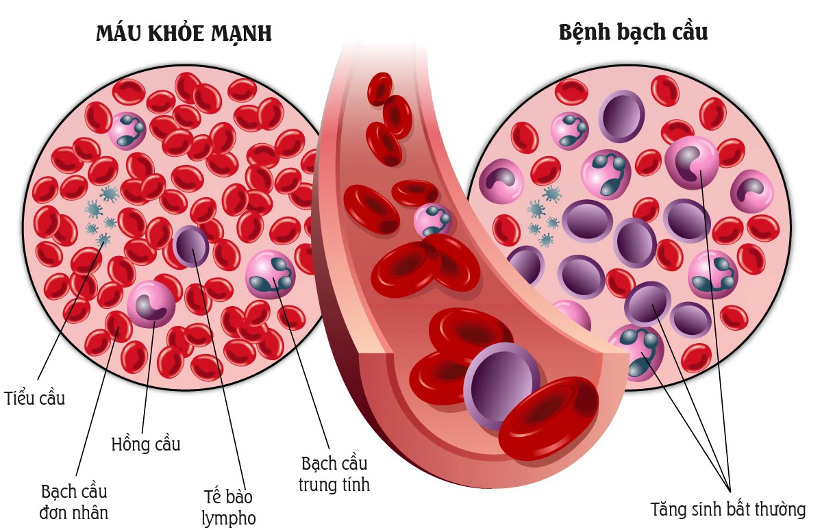 tình trạng tăng bất thường số lượng tế bào bạch cầu lympho