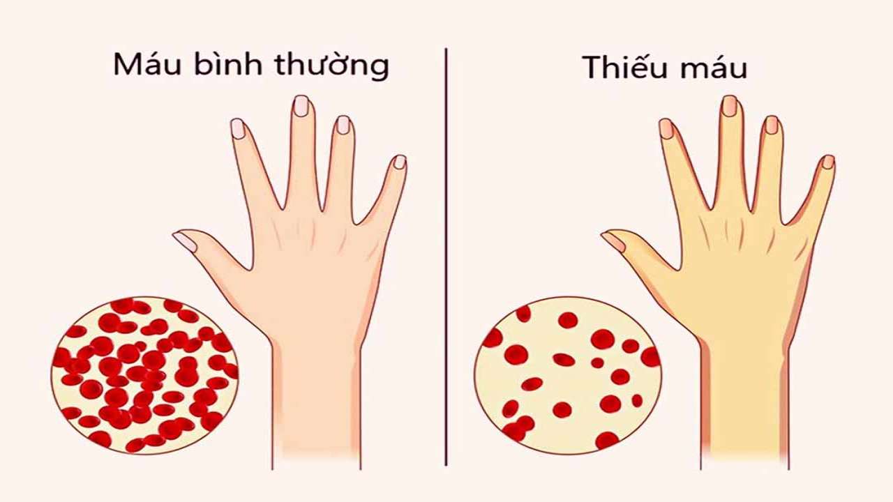 vàng da do thiếu máu