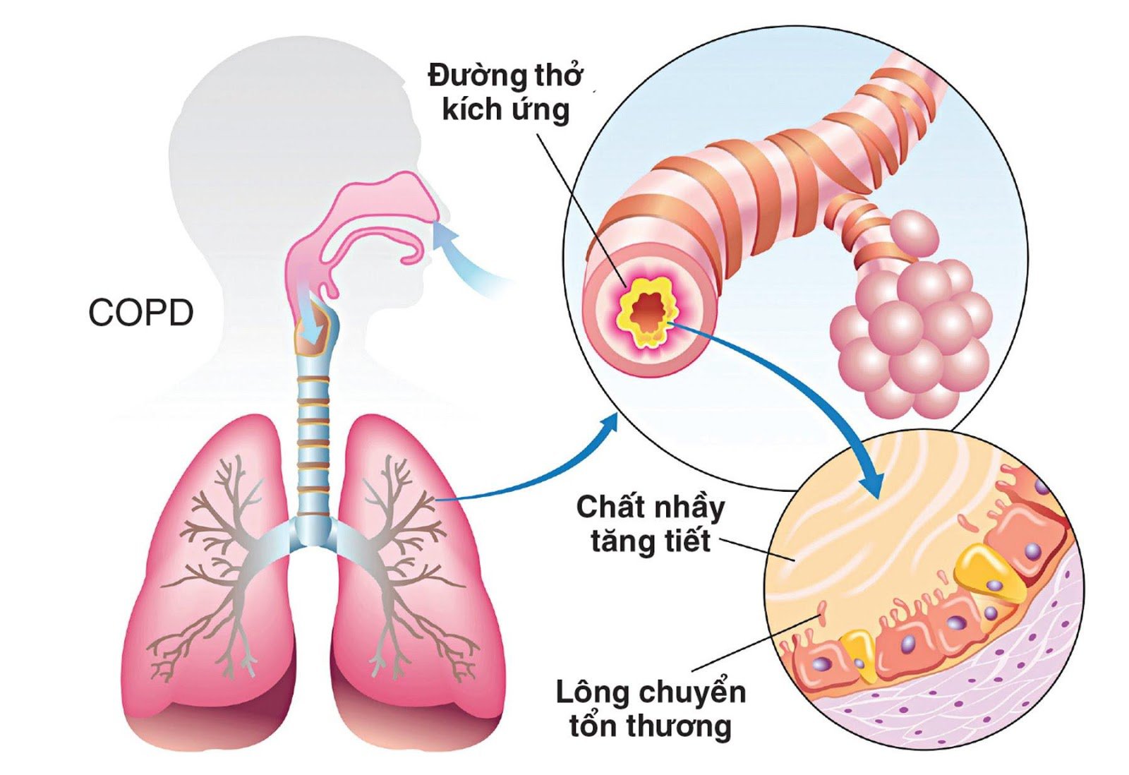 bệnh phổi tắc nghẽn mãn tính