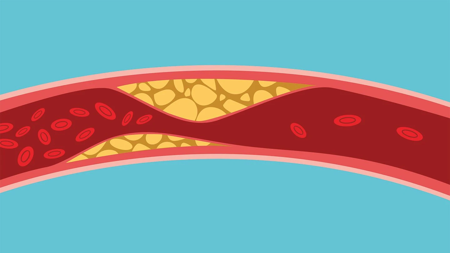 chất béo triglyceride tích tụ tại thành mạch