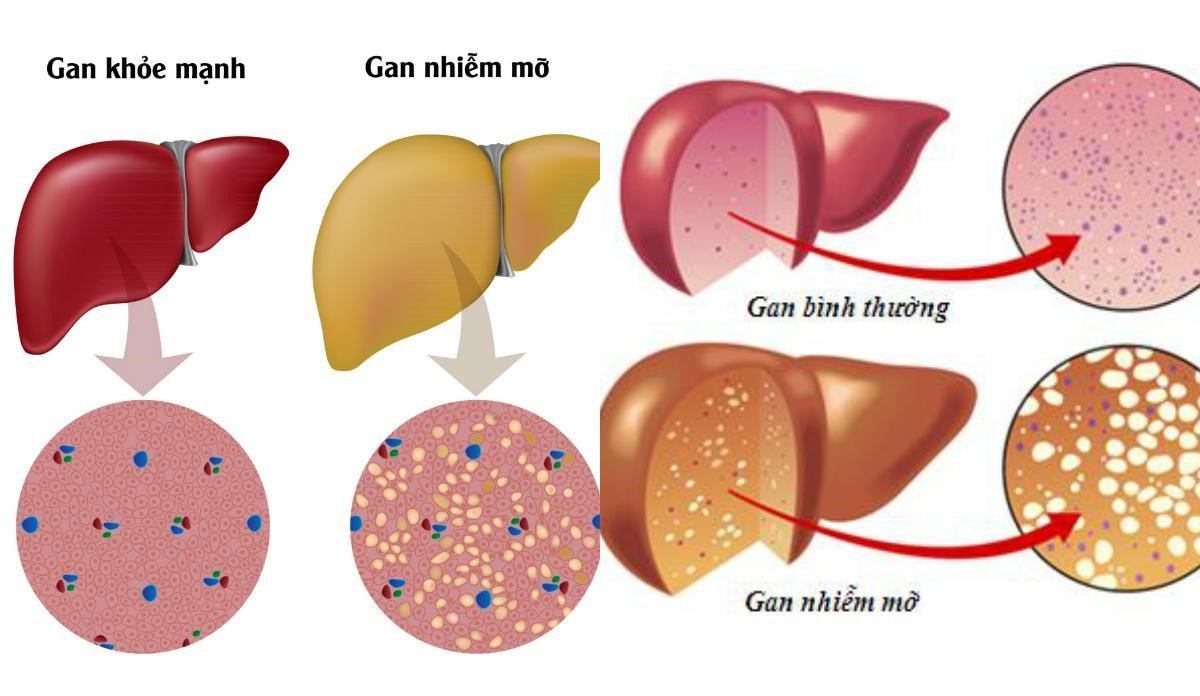 chỉ số ggt gây bệnh về gan