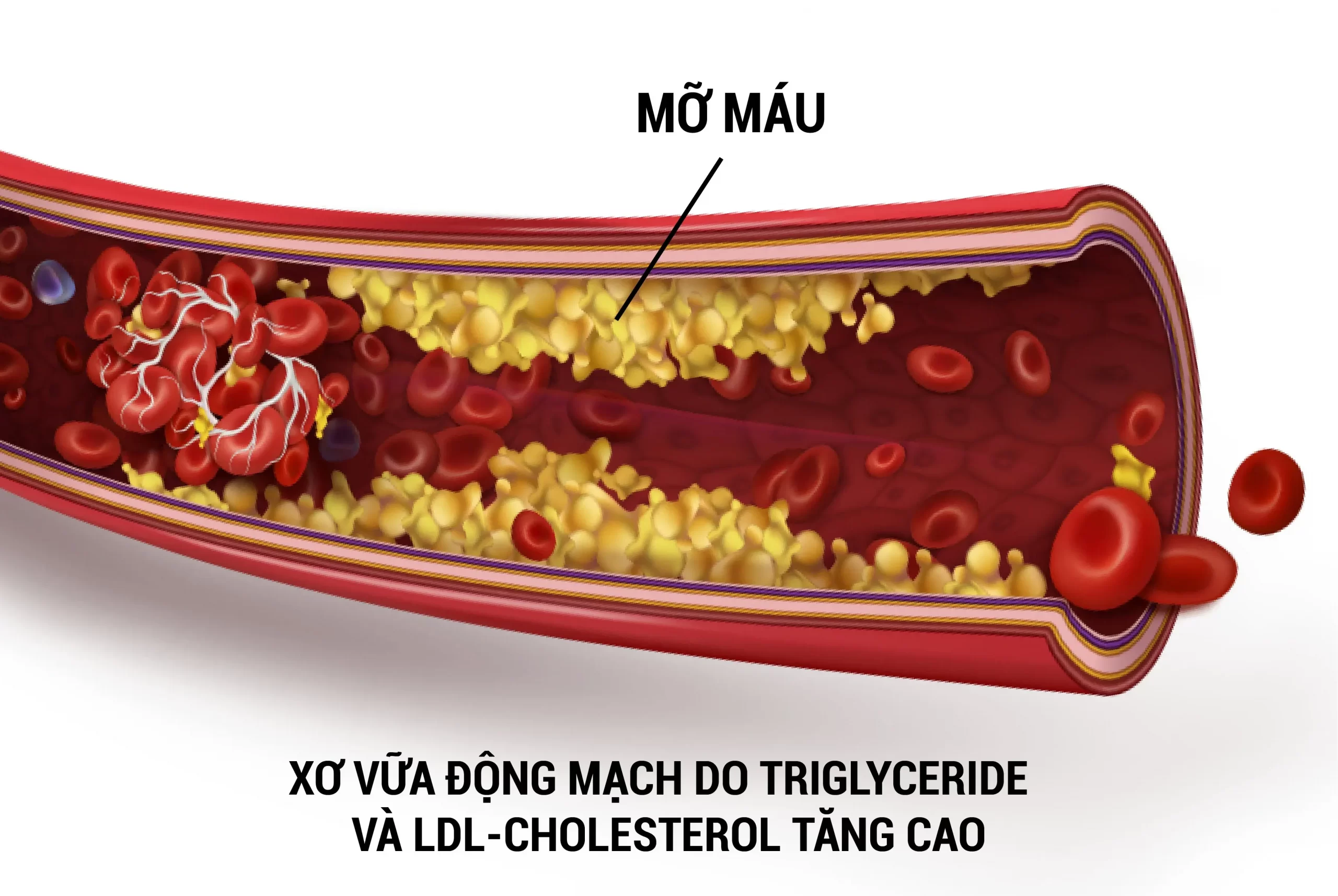 mỡ máu do chỉ số triglyceride tăng cao