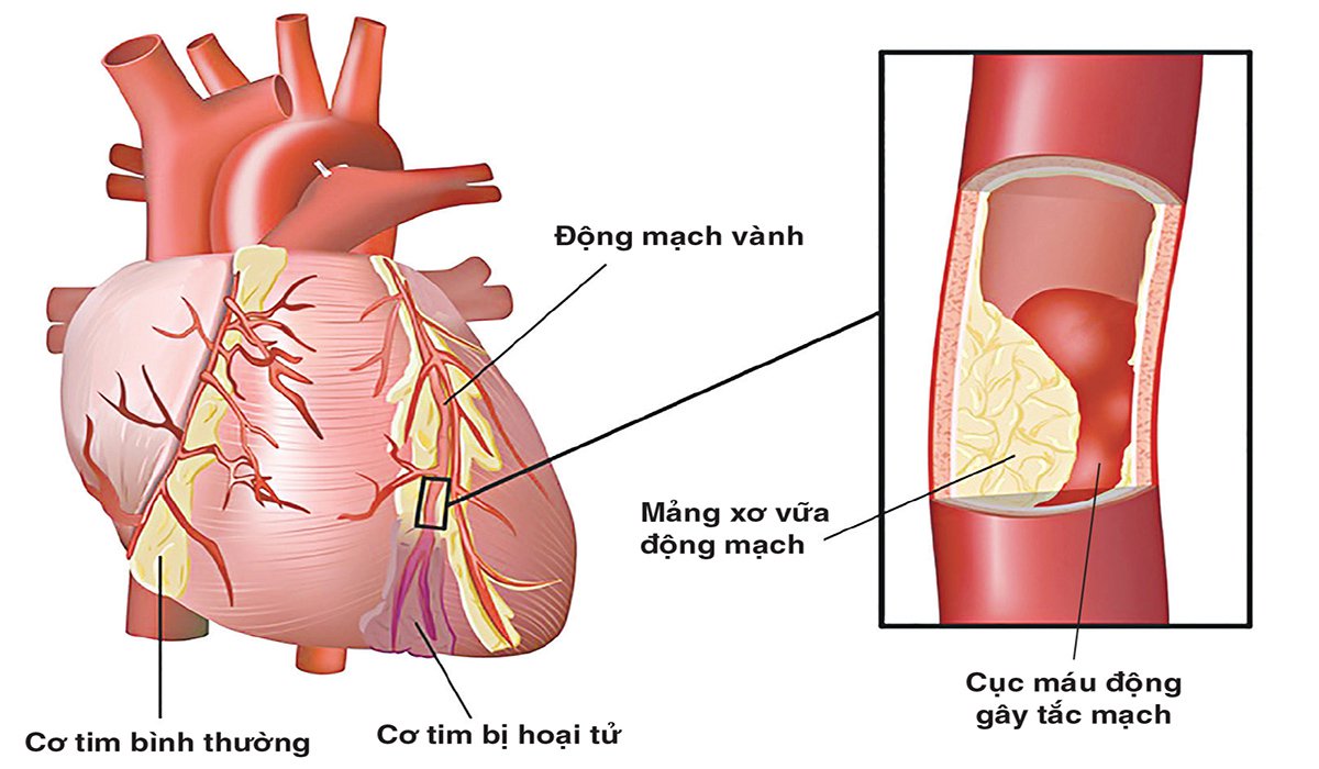 tăng chỉ số crp liên quan đến bệnh tim mạch