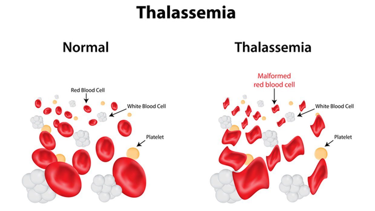 thalassemia