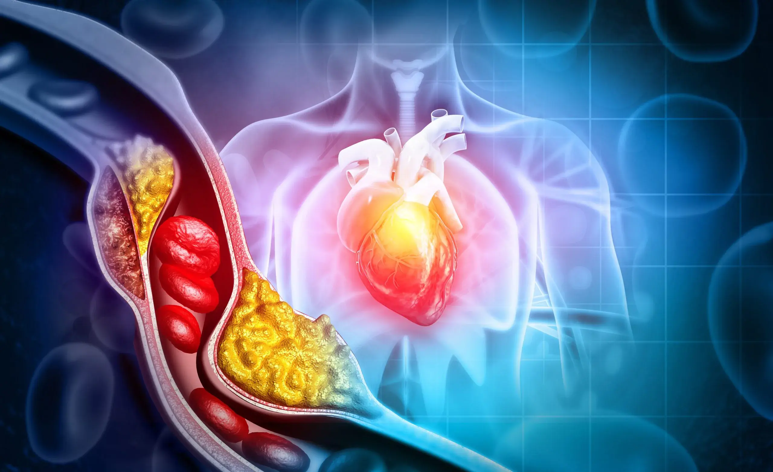 triglyceride gây bệnh về tim mạch