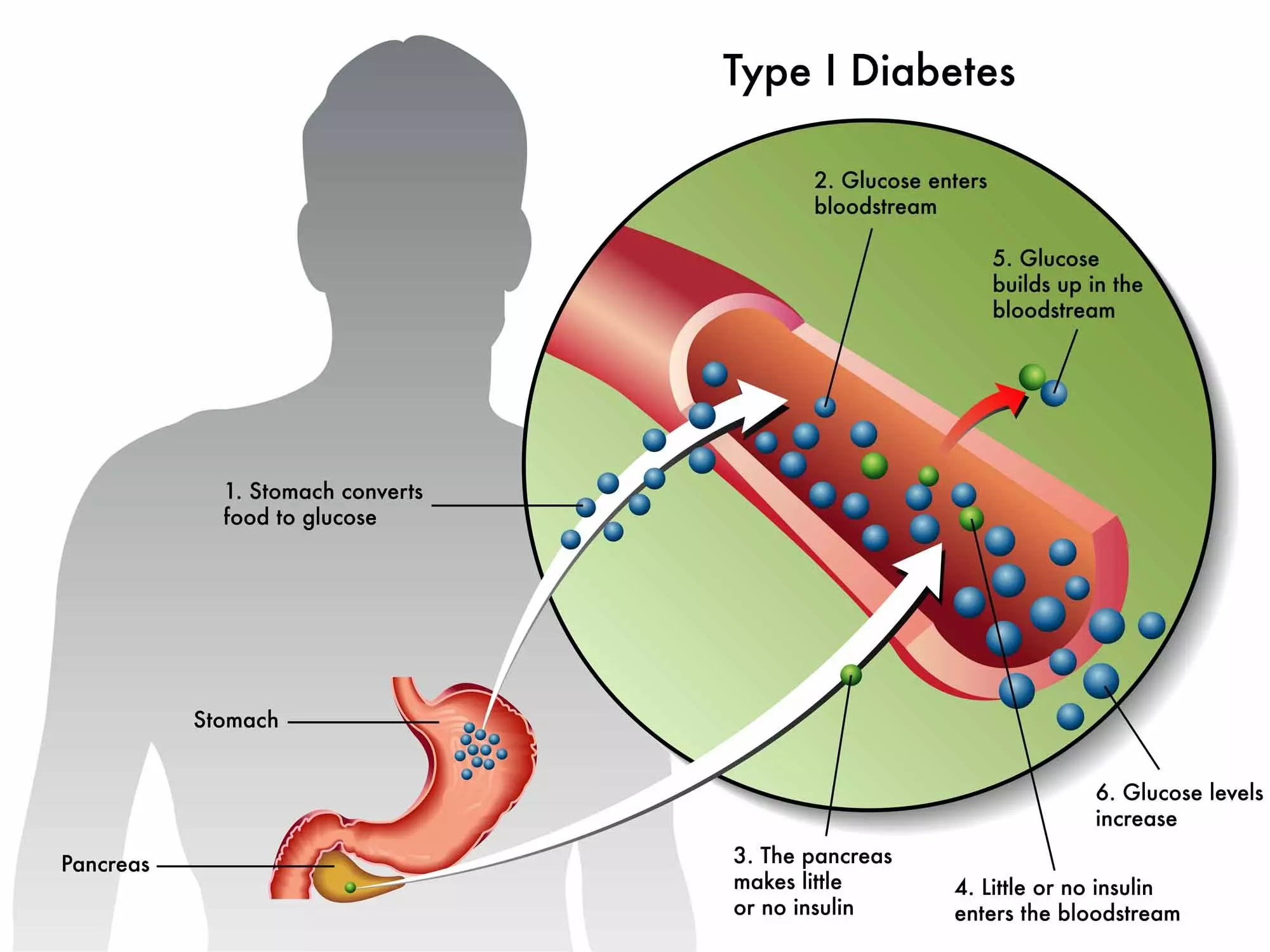 glucose và bệnh đái tháo đường tuýp 1