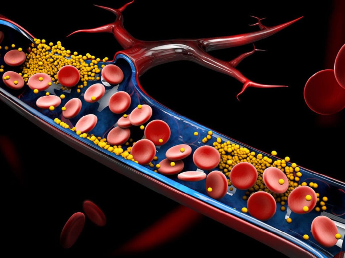 xơ vữa động mạch do cholesterol