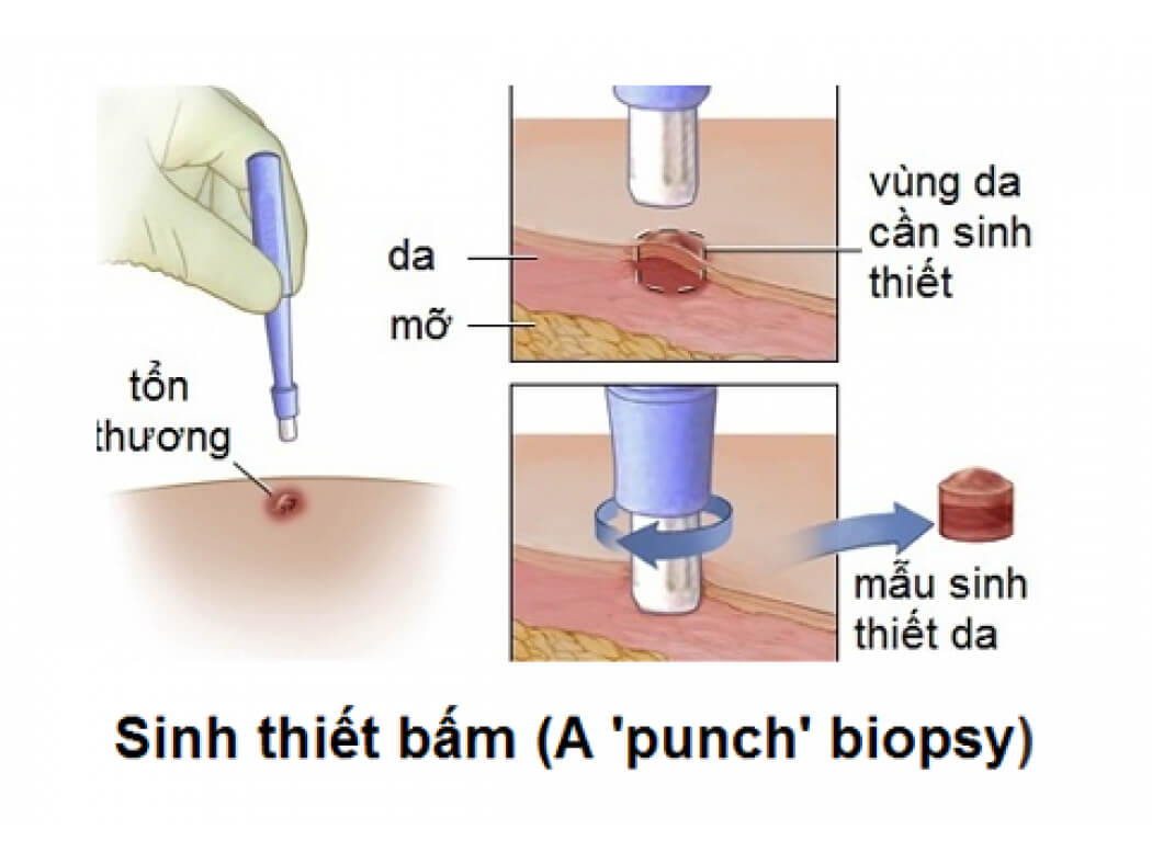 sinh thiết bấm