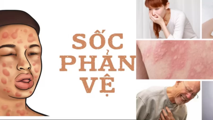 sốc phản vệ là gì