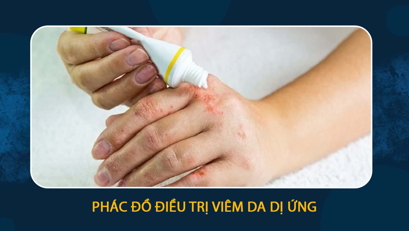 sử dụng thuốc bôi điều trị viêm da dị ứng