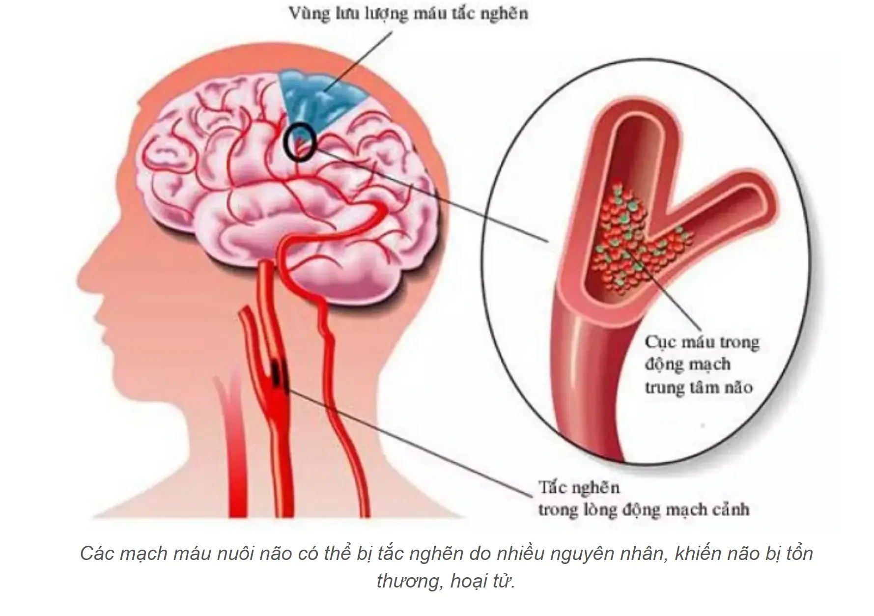 tắc nghẽn mạch máu não