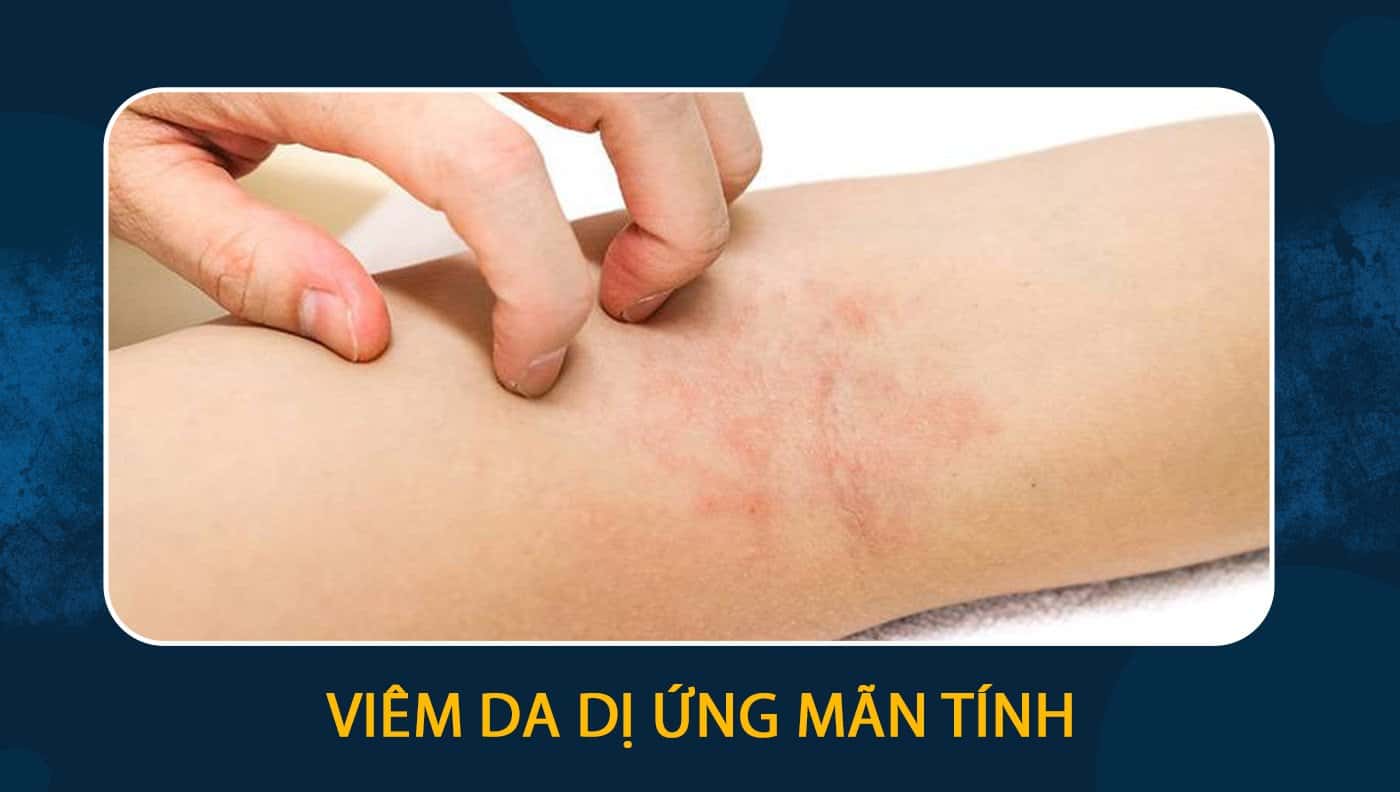 viêm da dị ứng mãn tính