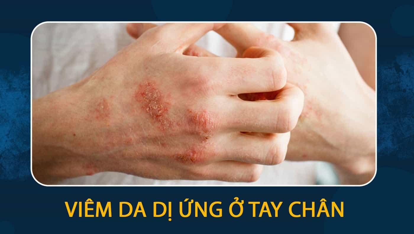 viêm da dị ứng ở tay chân