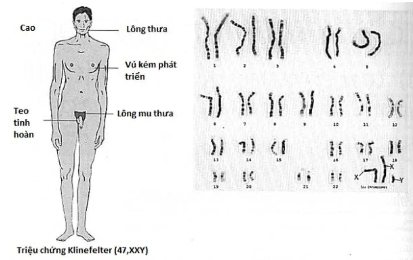 biểu hiện người mắc hội chứng klinefelter