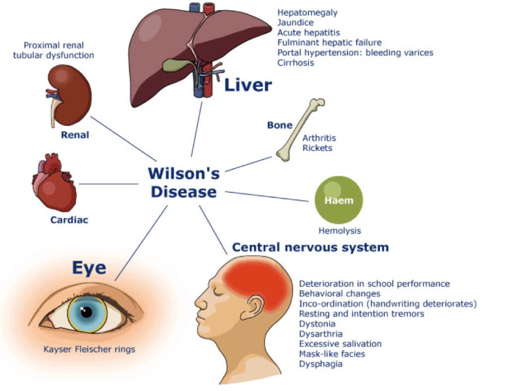 một số dấu hiệu bệnh wilson