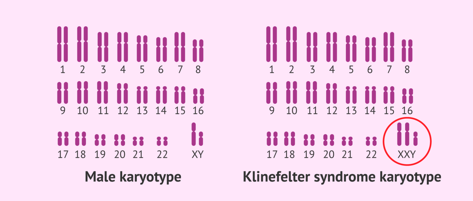 nguyên nhân gây hội chứng klinefelter