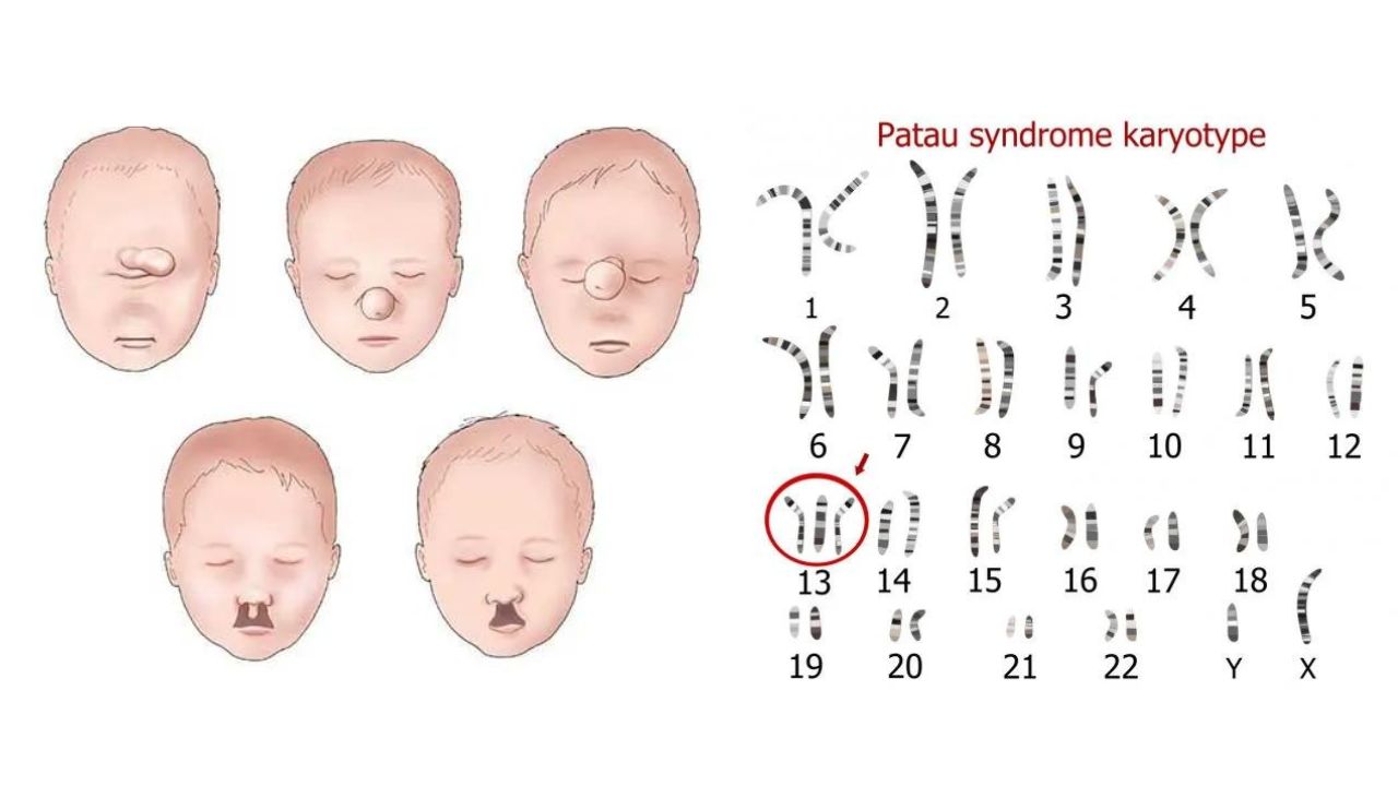 rối loạn di truyền nhiễm sắc thể số 13