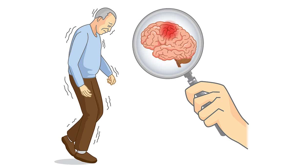 tổn thương não ở người mắc bệnh parkinson