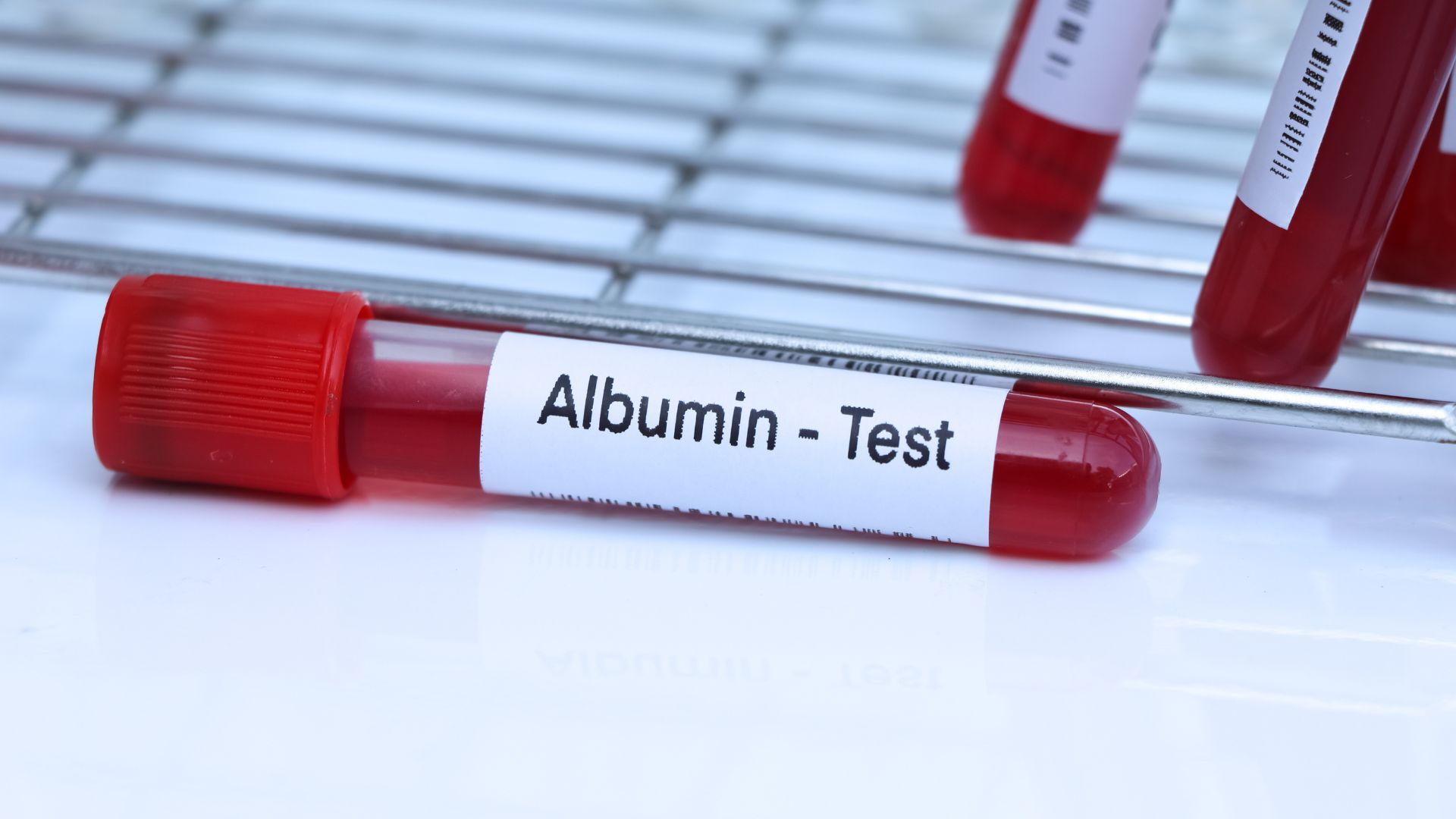 xét nghiệm albumin bằng mẫu máu