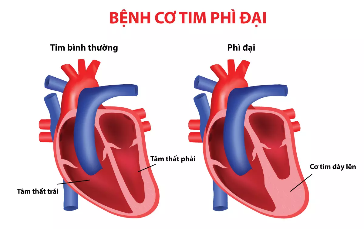 xét nghiệm inr với người bị hở van tim