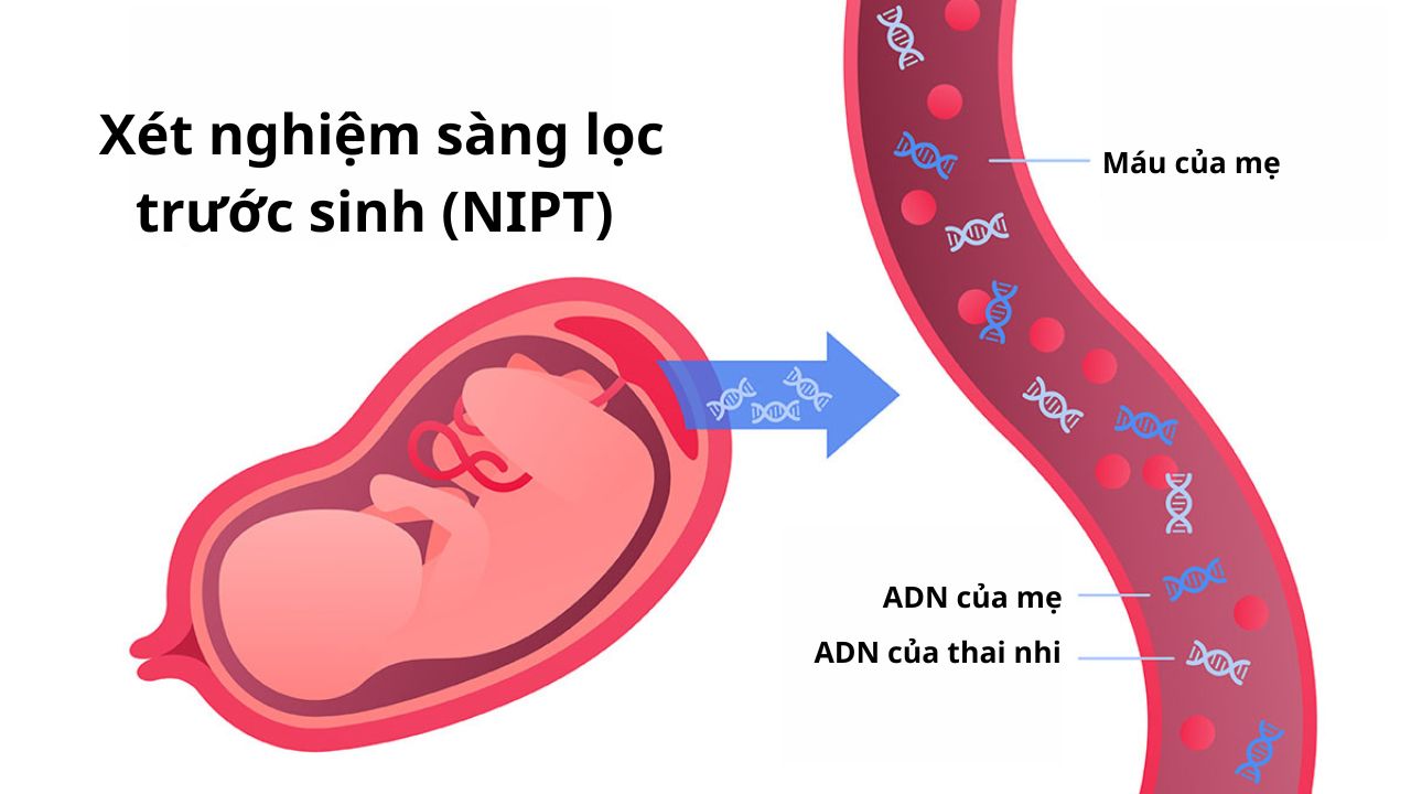 xét nghiệm sàng lọc chẩn đoán hội chứng turner