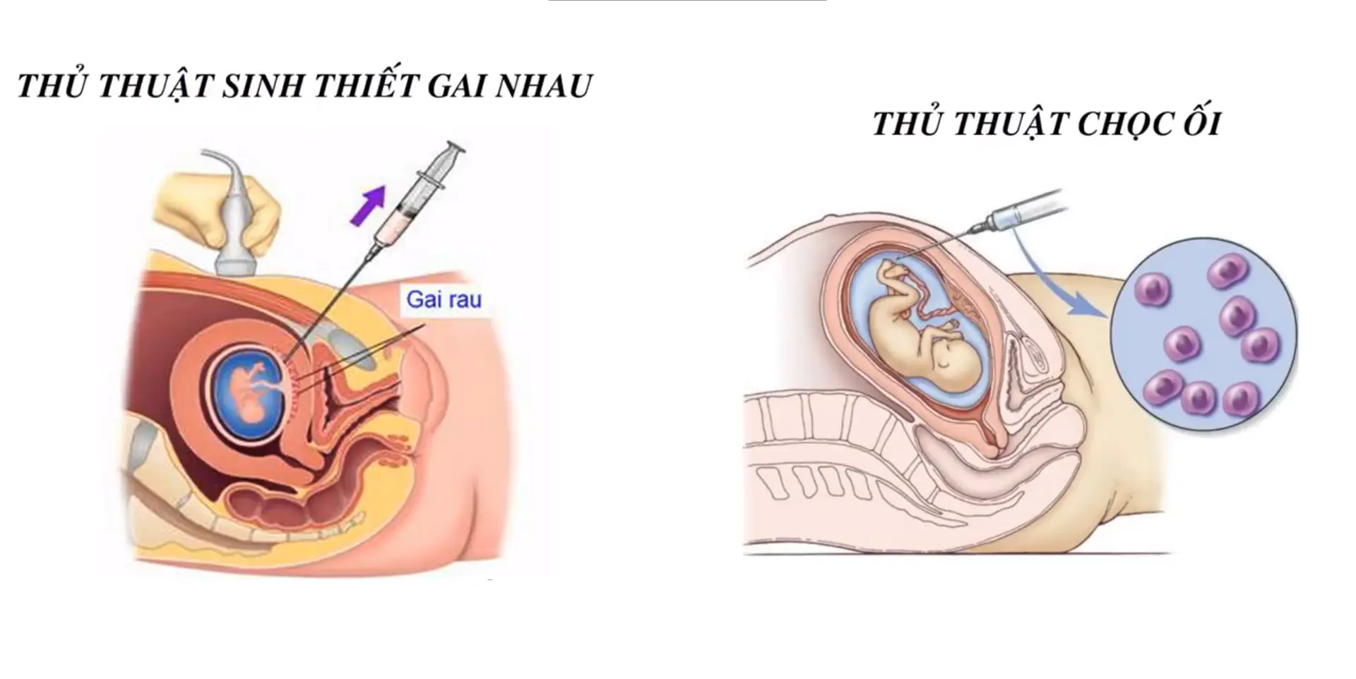 xét nghiệm sàng lọc hội chứng down