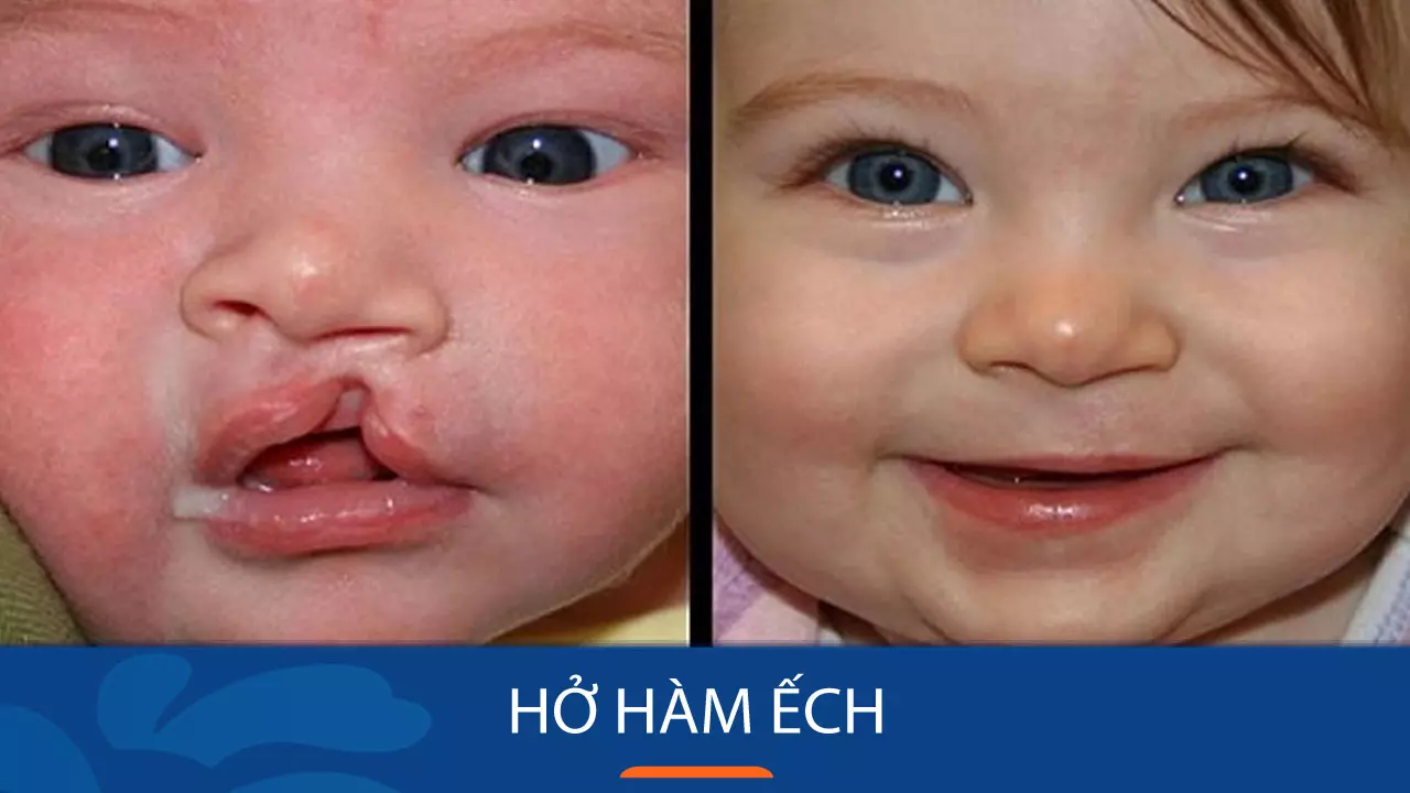 trẻ mắc hở hàm ếch và trẻ bình thường